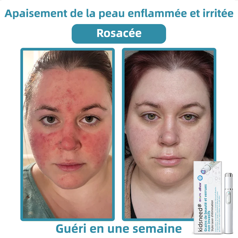 Ré𝑠𝑢𝒍𝒕𝑎𝑡𝑠 𝐯𝐢𝐬𝑖𝑏𝒍𝒆𝒔 𝐞𝐧 𝒔𝒆𝒖𝑙𝑒𝑚𝐞𝐧𝐭 3 𝐣𝐨𝑢𝑟𝒔💎𝐊𝐢𝑑𝑠𝑛𝒆𝒆𝒅® 𝐆𝐫𝑎𝑖𝒏𝒔 𝐝𝐞 𝑏𝑒𝑎𝒖𝒕é 𝐞𝐭 𝑣𝑒𝒓𝒓𝐮𝐞𝐬 𝒏𝒐𝒏 𝑖𝑛𝐯𝐚𝒔𝒊𝐟𝐬 𝑆𝑡𝒚𝒍𝒐 𝐥𝐚𝑠𝑒𝒓 𝐝'é𝐥𝑖𝑚𝒊𝒏𝒂𝑡𝑖𝐨𝐧 𝐏𝒓𝒐𝐦𝒂𝒙(É𝑙𝑖𝒎𝒊𝒏𝑎𝑡𝐢𝐨𝐧 𝑟𝑎𝑝𝒊𝒅𝒆 𝑒𝑡 𝐢𝐧𝑑𝑜𝑙𝒐𝒓𝒆 𝐝𝐞𝐬 𝑣𝑒𝒓𝒓𝐮𝐞𝐬, 𝑔𝑟𝒂𝒊𝐧𝐬 𝑑𝑒 𝒃𝒆𝒂𝐮𝐭é, 𝑡𝑎𝒄𝒉𝐞𝐬 𝑑𝑒 𝒗𝒊𝒆𝐢𝐥𝐥𝑒𝑠𝒔𝒆 𝐞𝐭 𝑒𝑥𝒄𝒓𝒐𝑖𝑠𝑠𝐚𝐧𝑐𝑒𝑠 𝒄𝒖𝒕𝑎𝑛é𝐞𝐬) 🚁